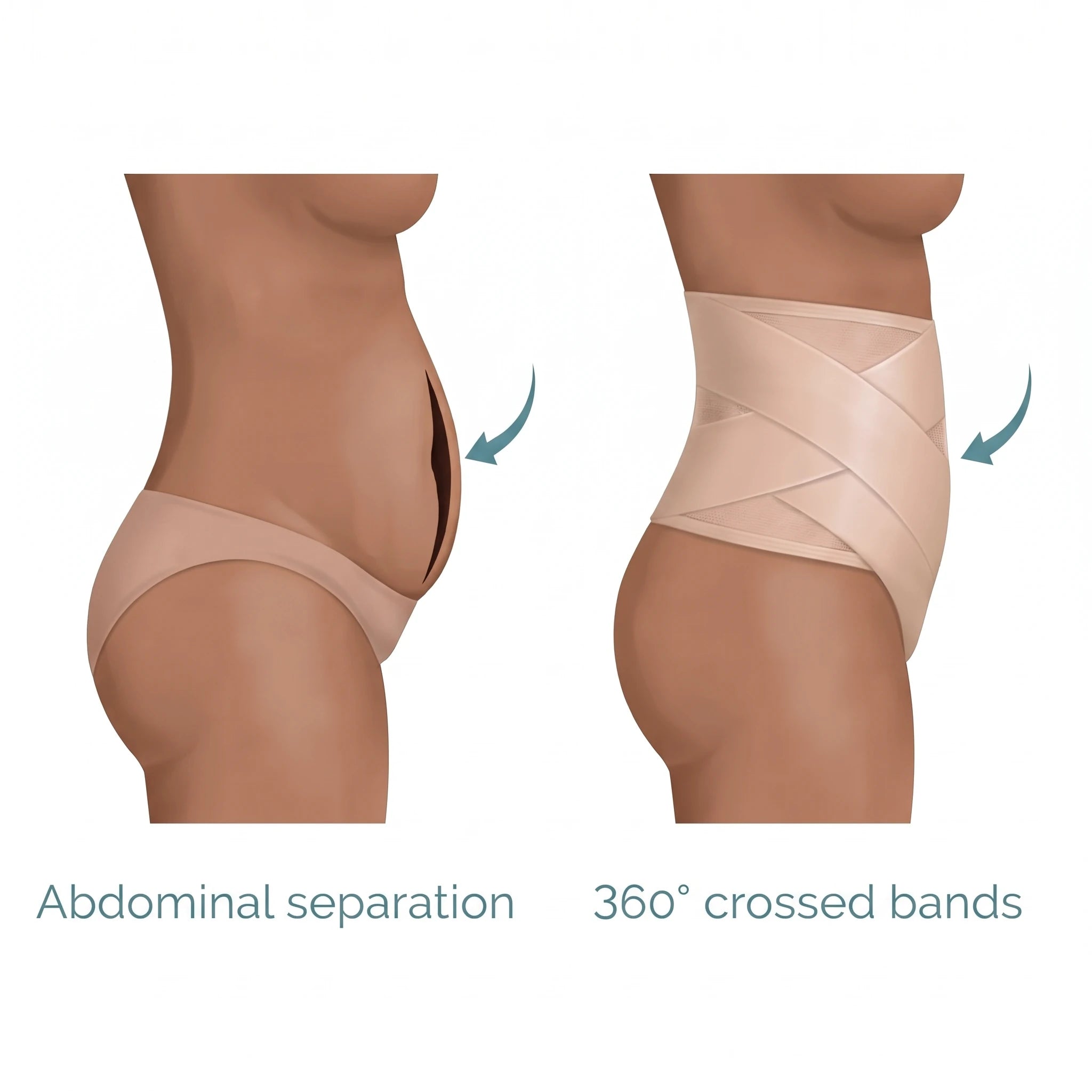 Diagram: abdominal separation compared with 360 degree crossed band support
